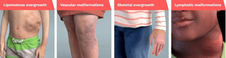 Lipomatous overgrowth, vascular malformations, skeletal overgrowth, lymphatic malformations